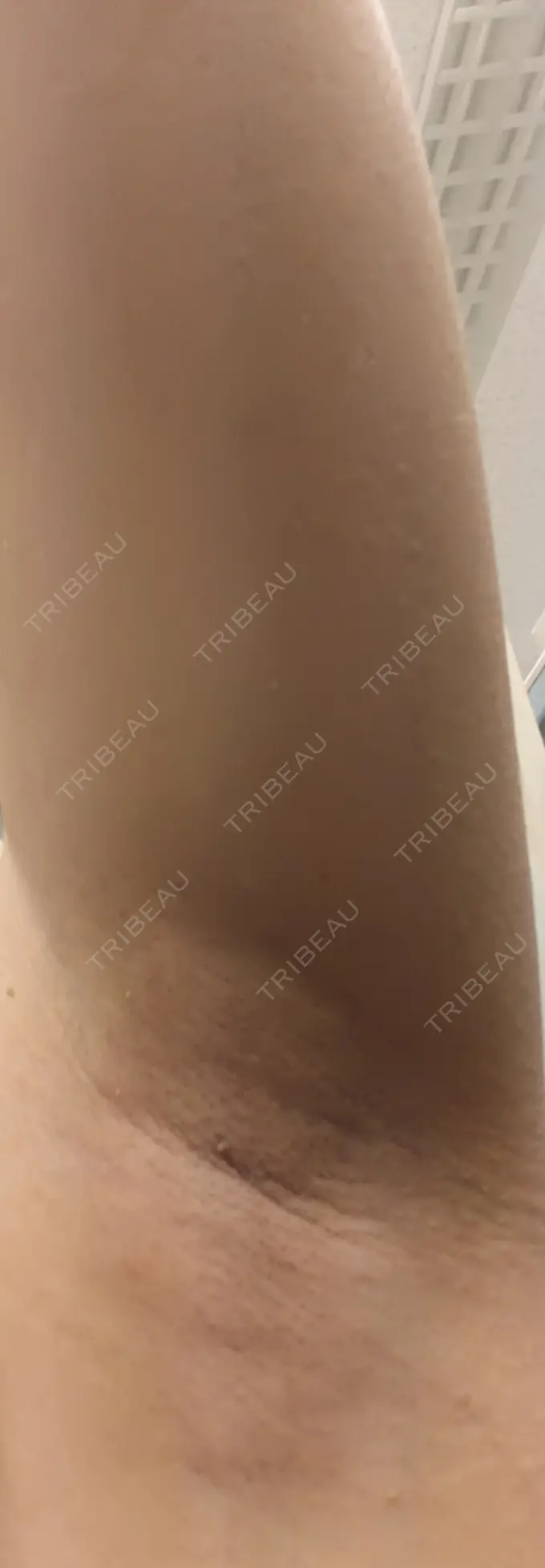 ワキ汗治療（レーザー） フォンタナクリニック天神 DAY 3 メイン用