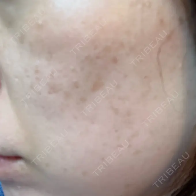 フラクショナルレーザー（毛穴・ニキビ跡） Designo Clinic （デジーノクリニック） DAY 7 メイン用