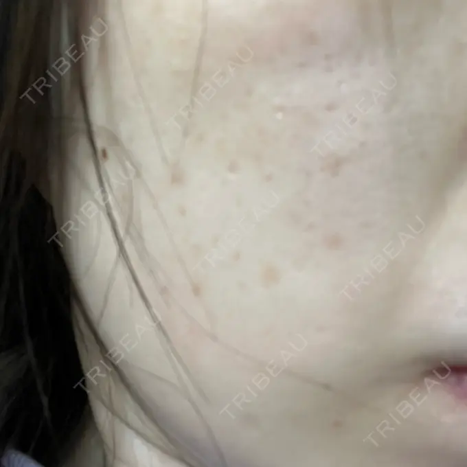 フラクショナルレーザー（毛穴・ニキビ跡） Designo Clinic （デジーノクリニック） AFTER メイン用