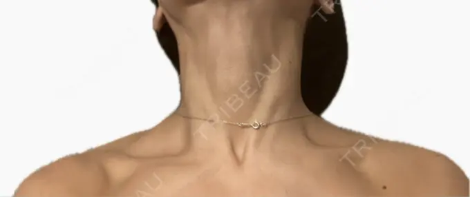 ボトックス（肩） / ボトックス（首） アールクリニック DAY 8 メイン用