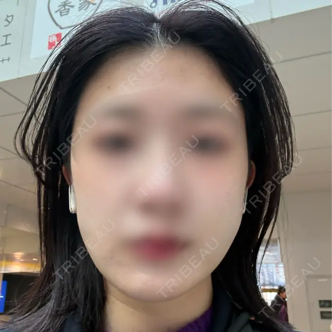 糸リフト / 脂肪吸引（顔） 下北沢スキンクリニック DAY 11 メイン用