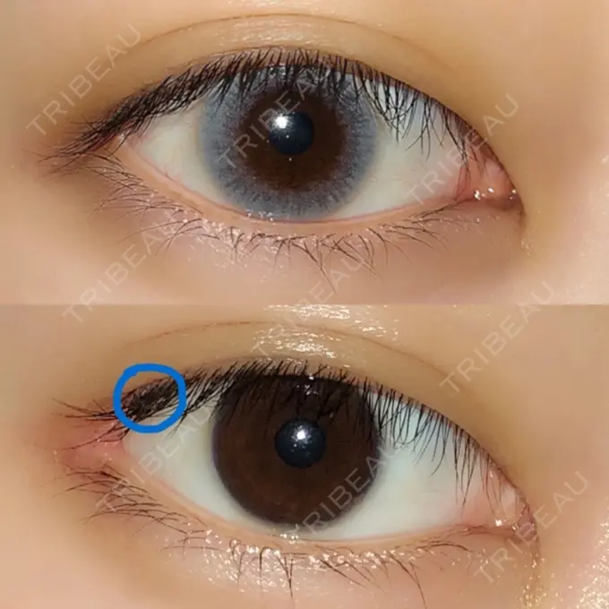 目頭切開 / 目尻切開 エートップ美容整形外科 DAY 61 メイン用