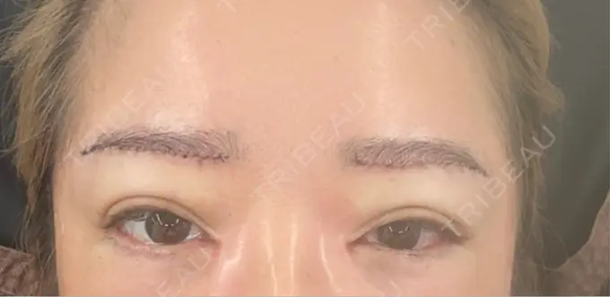 下まぶたたるみ取り / 下まぶたの脂肪取り / 眉下切開 / その他（目元） LOCHIC CLINIC GINZA【ロシッククリニック銀座】 AFTER メイン用