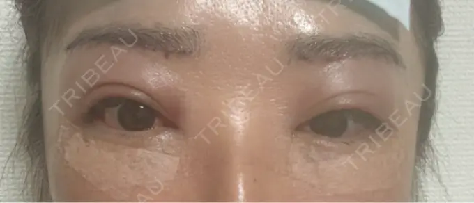 下まぶたたるみ取り / 下まぶたの脂肪取り / 眉下切開 / その他（目元） LOCHIC CLINIC GINZA【ロシッククリニック銀座】 DAY 0 メイン用