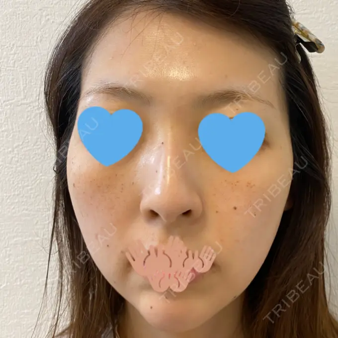 イオン導入 / ピーリング（ハリ・ツヤ） / ルメッカ ルラ美容クリニック 千葉院 / ルラスキンクリニック 千葉院 AFTER メイン用