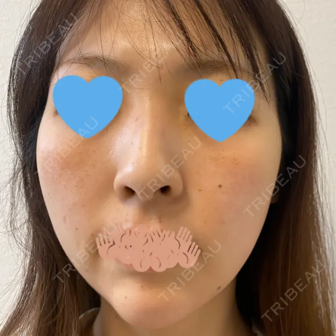 イオン導入 / ピーリング（ハリ・ツヤ） / ルメッカ ルラ美容クリニック 千葉院 / ルラスキンクリニック 千葉院 DAY 1 メイン用