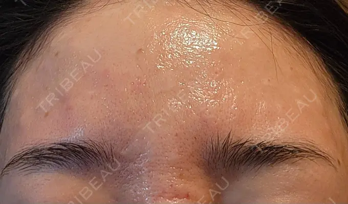 リジュラン 湘南美容クリニック Regno 銀座院 DAY 0 メイン用