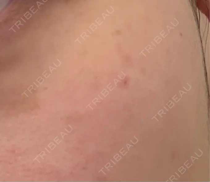 ルメッカ PureMe Skin Clinic（ピュアミースキンクリニック麻布） DAY 0 メイン用