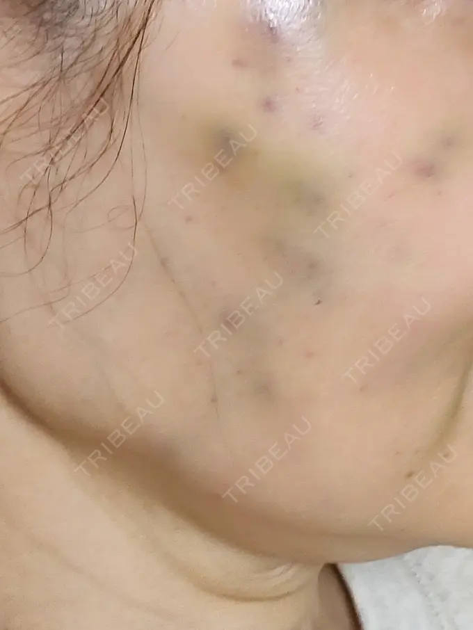 水光注射（ハリ・美肌） APスキンクリニック銀座 DAY 1 メイン用