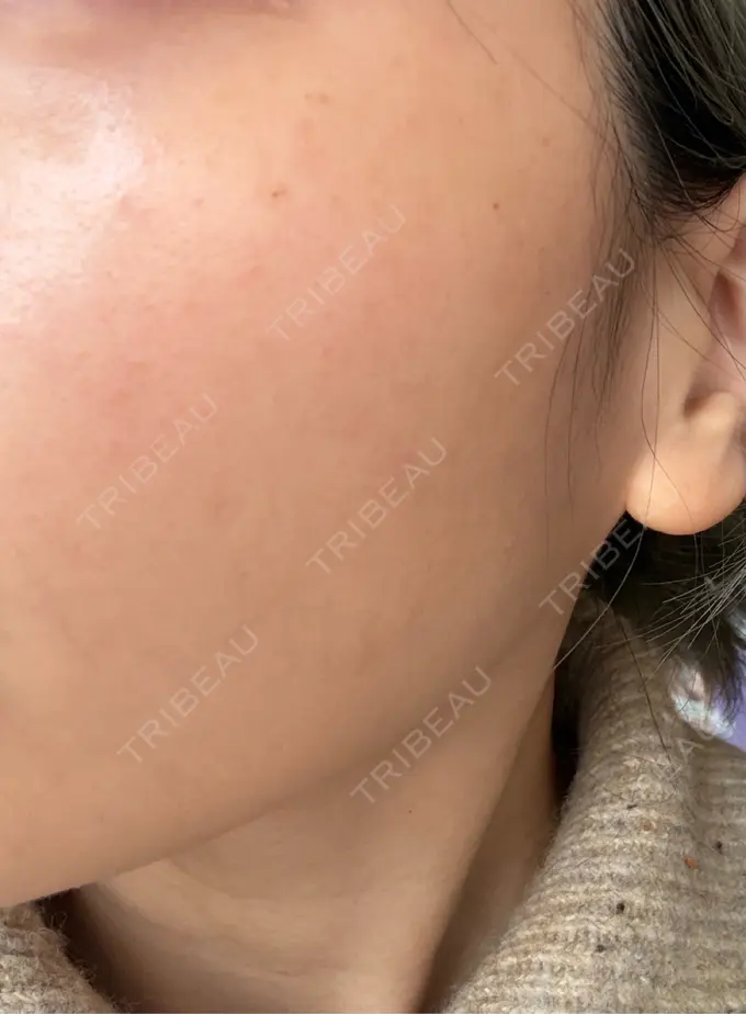 ルメッカ PureMe Skin Clinic（ピュアミースキンクリニック麻布） DAY 1 メイン用