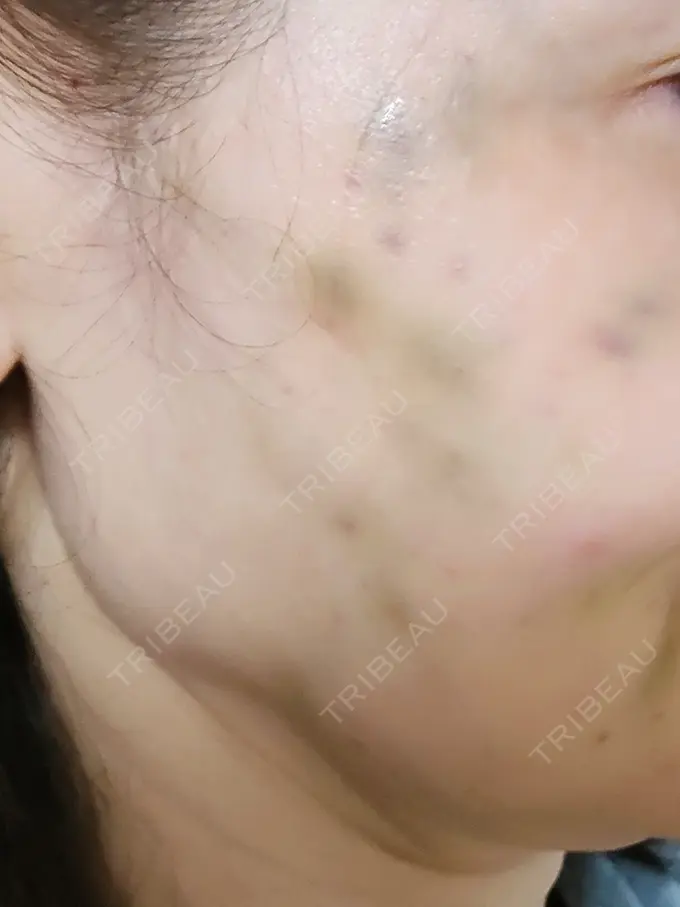 水光注射（ハリ・美肌） APスキンクリニック銀座 DAY 2 メイン用