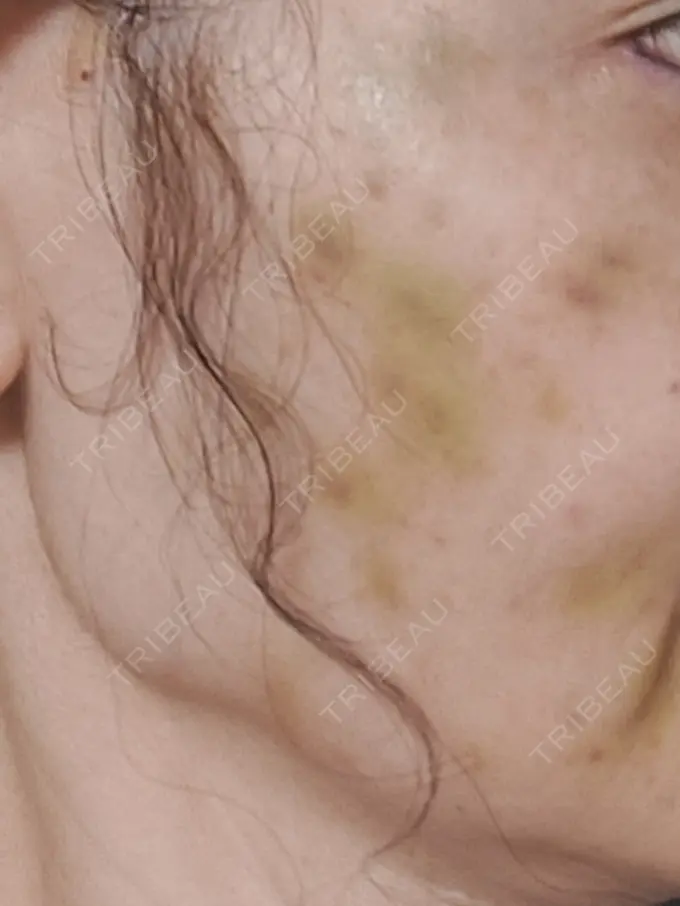 水光注射（ハリ・美肌） APスキンクリニック銀座 AFTER メイン用