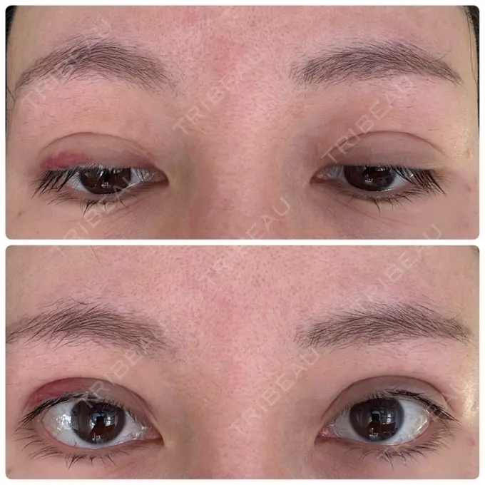 二重埋没 湘南美容クリニック 博多院 DAY 14 メイン用