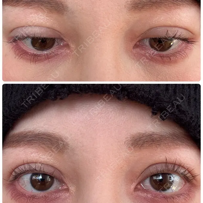 二重埋没 湘南美容クリニック 博多院 DAY 14 メイン用