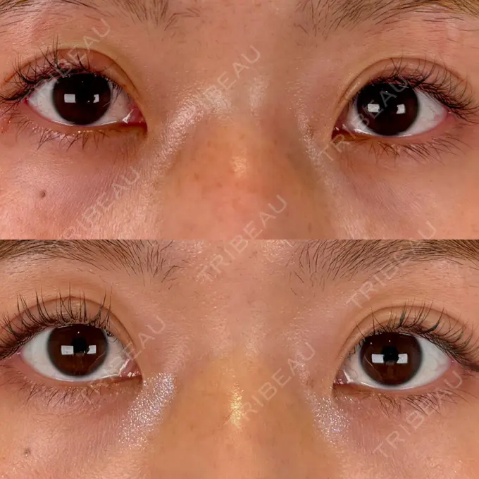 眼瞼下垂（非切開） SOL CLINIC AFTER メイン用