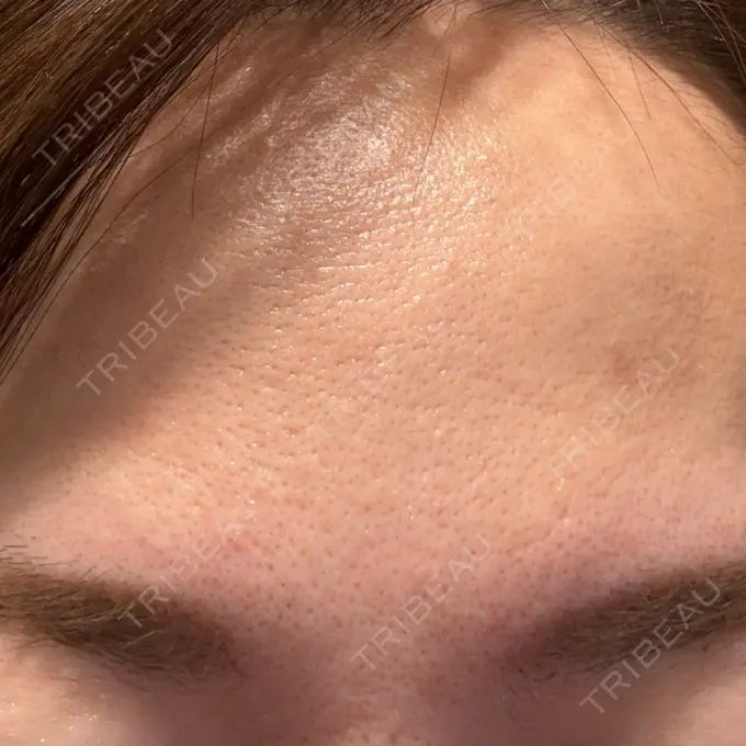 ボトックス（眉間） TCB東京中央美容外科 千葉駅前院 DAY 0 メイン用