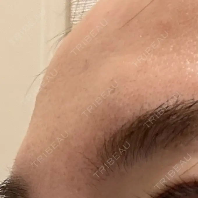 ボトックス（眉間） TCB東京中央美容外科 千葉駅前院 DAY 0 メイン用