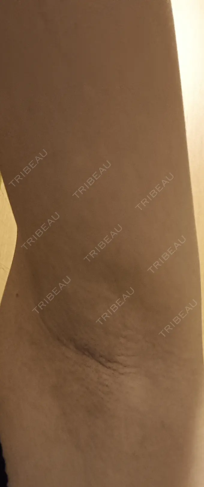 ワキ汗治療（レーザー） フォンタナクリニック天神 DAY 4 メイン用