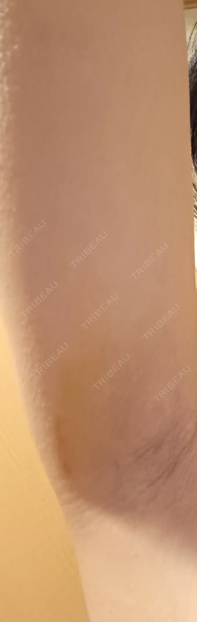 ワキ汗治療（レーザー） フォンタナクリニック天神 DAY 4 メイン用