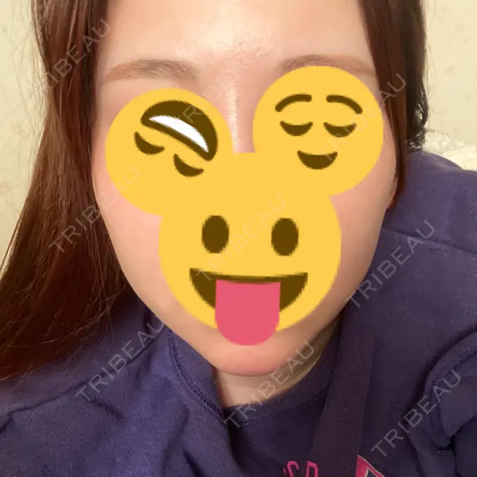 ボトックス（あご） / ヒアルロン酸注入（あご） / ハイフ（顔） / RF（高周波）たるみ治療 ルラ美容クリニック 名古屋栄院 / ルラスキンクリニック 名古屋栄院 DAY 2 メイン用