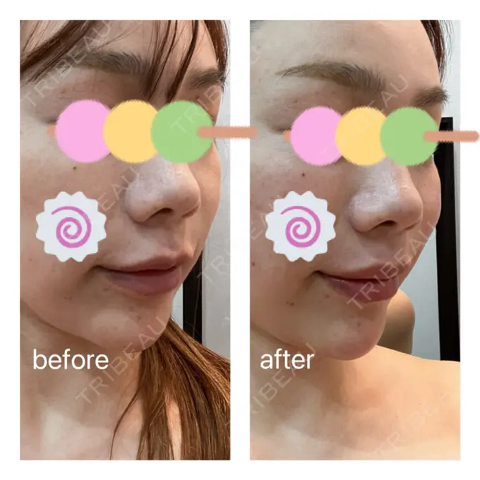 インディバ（顔） WOM SALON【術後ケア取扱いサロン】 DAY 0 メイン用