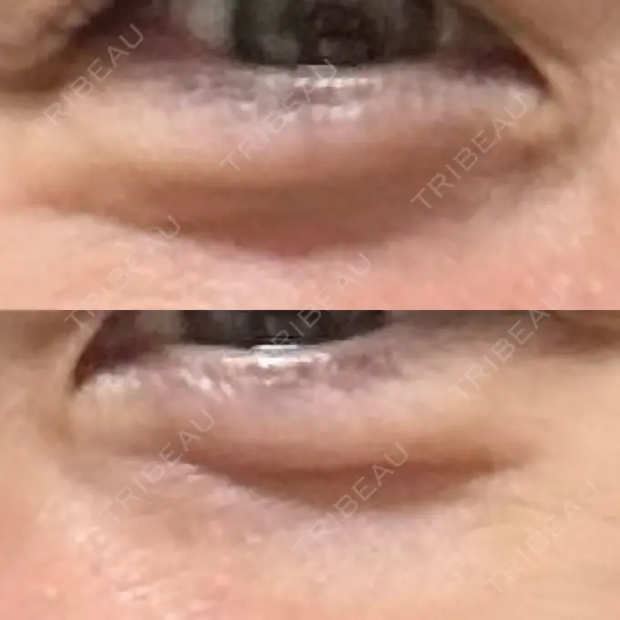 クマ治療 セオリークリニック AFTER メイン用