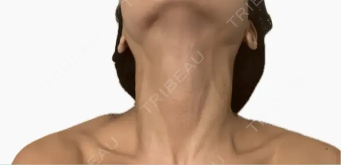 ボトックス（肩） / ボトックス（首） アールクリニック AFTER メイン用