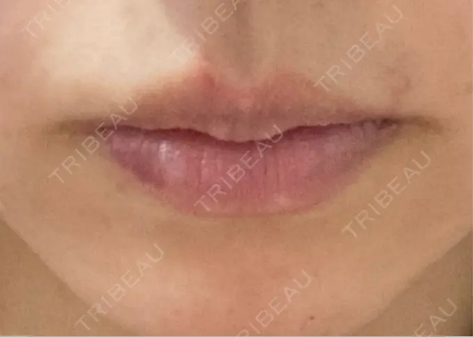 ヒアルロン酸注入（唇） HAAB×DREAM BEAUTY CLINIC 大阪梅田院 DAY 4 メイン用