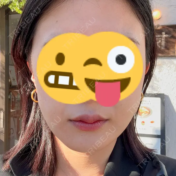 糸リフト / 脂肪吸引（顔） 下北沢スキンクリニック DAY 12 メイン用