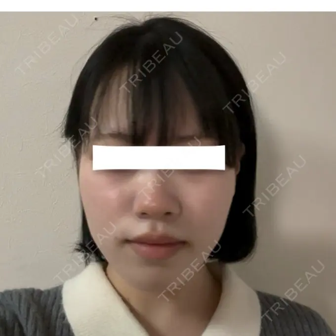 糸リフト / 脂肪吸引（顔） / ジョールファット除去 / 脂肪吸引注射（顔） / ボトックス（エラ・小顔） SEA CLINIC（シークリニック） AFTER メイン用