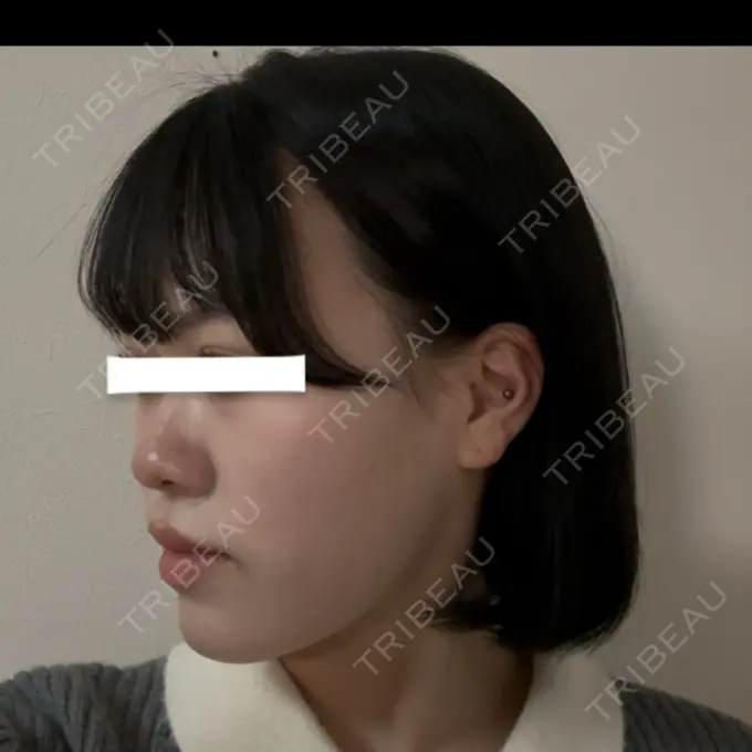 糸リフト / 脂肪吸引（顔） / ジョールファット除去 / 脂肪吸引注射（顔） / ボトックス（エラ・小顔） SEA CLINIC（シークリニック） DAY 126 メイン用