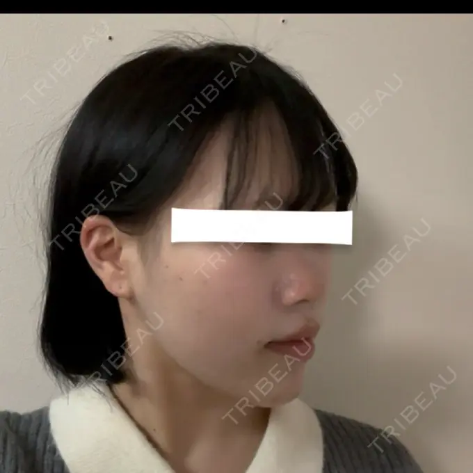 糸リフト / 脂肪吸引（顔） / ジョールファット除去 / 脂肪吸引注射（顔） / ボトックス（エラ・小顔） SEA CLINIC（シークリニック） DAY 126 メイン用