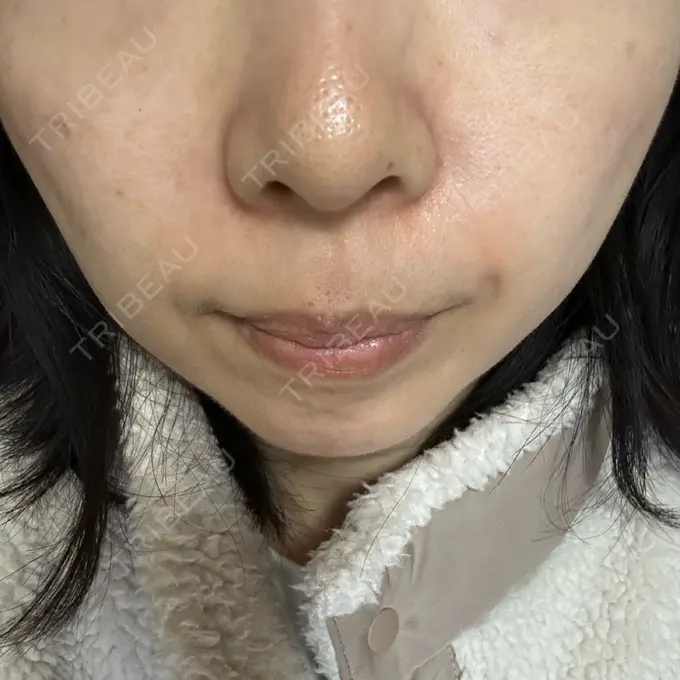 光治療（フォトフェイシャルなど） Sea Sail Beauty Clinic DAY 9 メイン用