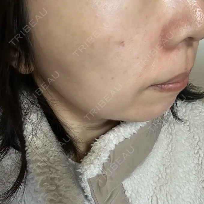 光治療（フォトフェイシャルなど） Sea Sail Beauty Clinic DAY 9 メイン用