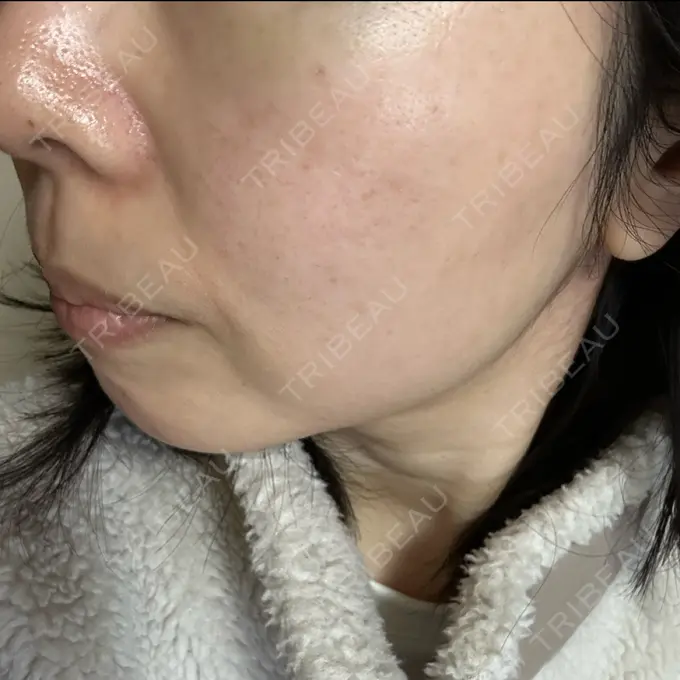 光治療（フォトフェイシャルなど） Sea Sail Beauty Clinic DAY 9 メイン用