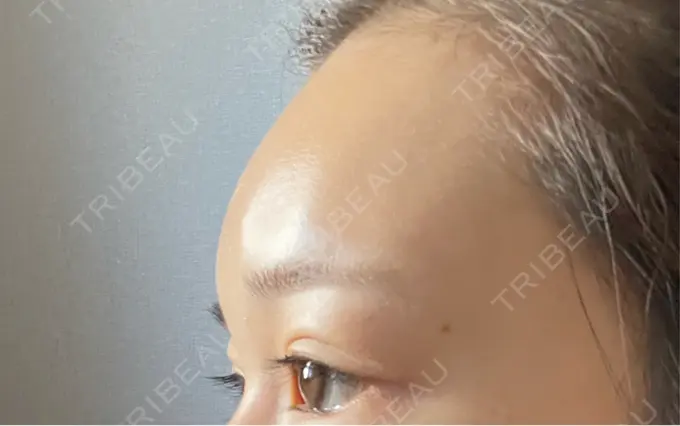 ヒアルロン酸注入（額） / ボトックス（眉間） / ボトックス（額） DMTC美容皮膚科 大宮院 DAY 2 メイン用