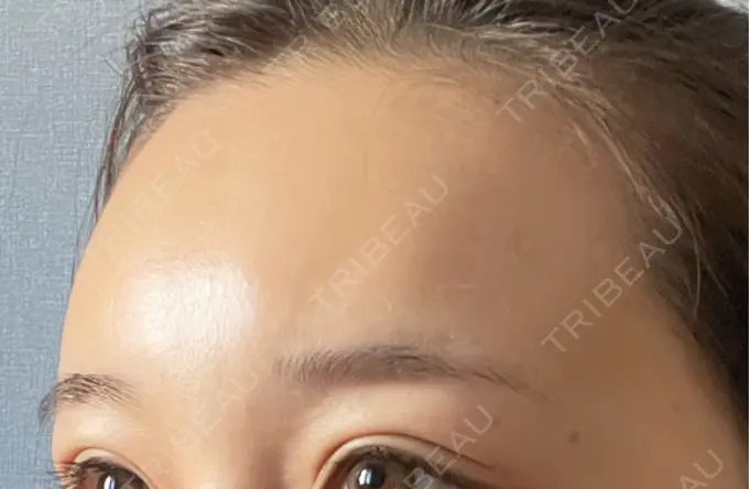 ヒアルロン酸注入（額） / ボトックス（眉間） / ボトックス（額） DMTC美容皮膚科 大宮院 DAY 2 メイン用