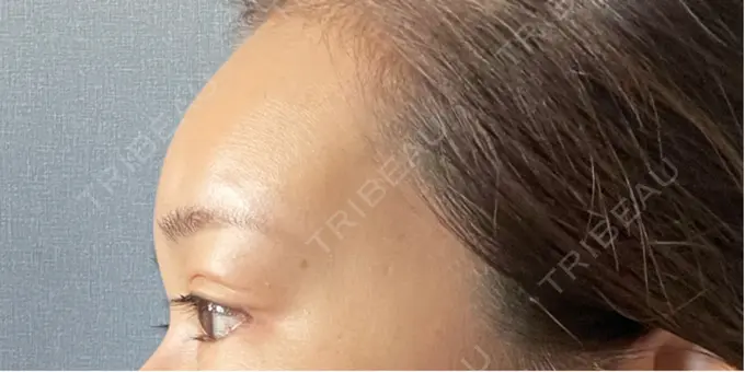 ヒアルロン酸注入（額） / ボトックス（眉間） / ボトックス（額） DMTC美容皮膚科 大宮院 DAY 2 メイン用