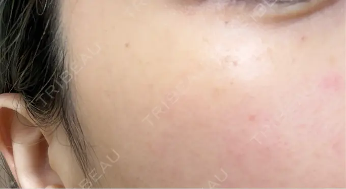 ルメッカ PureMe Skin Clinic（ピュアミースキンクリニック麻布） DAY 2 メイン用