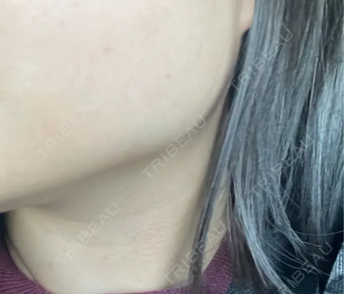 ボトックス（エラ・小顔） / ボトックス（首） DMTC CLINIC 渋谷院 AFTER メイン用