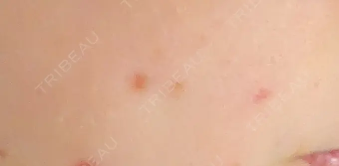 ほくろ・いぼ切除（肌） 札幌中央クリニック DAY 21 メイン用