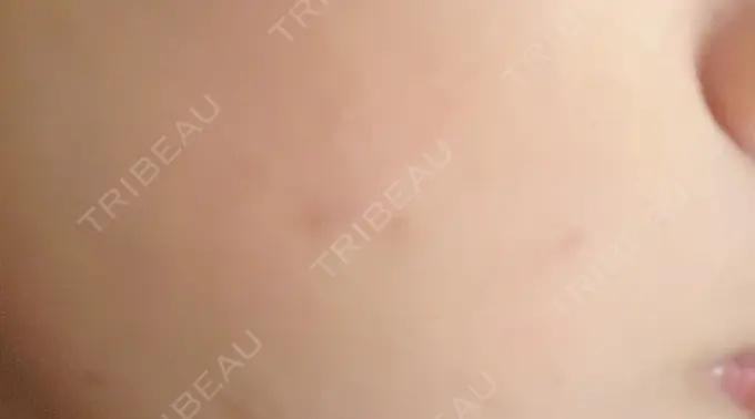 ほくろ・いぼ切除（肌） 札幌中央クリニック AFTER メイン用