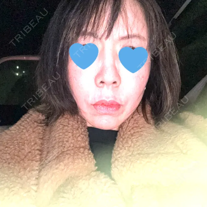 ボトックス（あご） / ボトックス（エラ・小顔） / ボトックス（口角） / ボトックス（肩） / ボトックス（眉間） / ボトックス（目尻） / ボトックス（額） / ボトックス（人中） おおたかの森ビューティークリニック DAY 0 メイン用