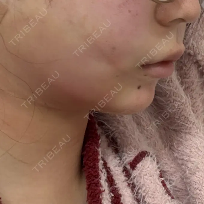 糸リフト / 脂肪吸引（顔） / ジョールファット除去 / 脂肪吸引注射（顔） / ヒアルロン酸注入（あご） / ボトックス（エラ・小顔） 新宿美容外科ネビュラクリニック DAY 1 メイン用