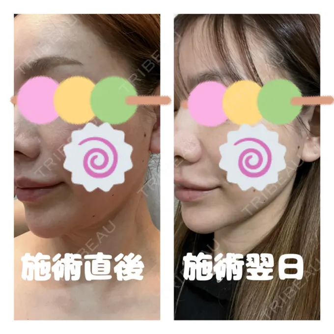 インディバ（顔） WOM SALON【術後ケア取扱いサロン】 AFTER メイン用