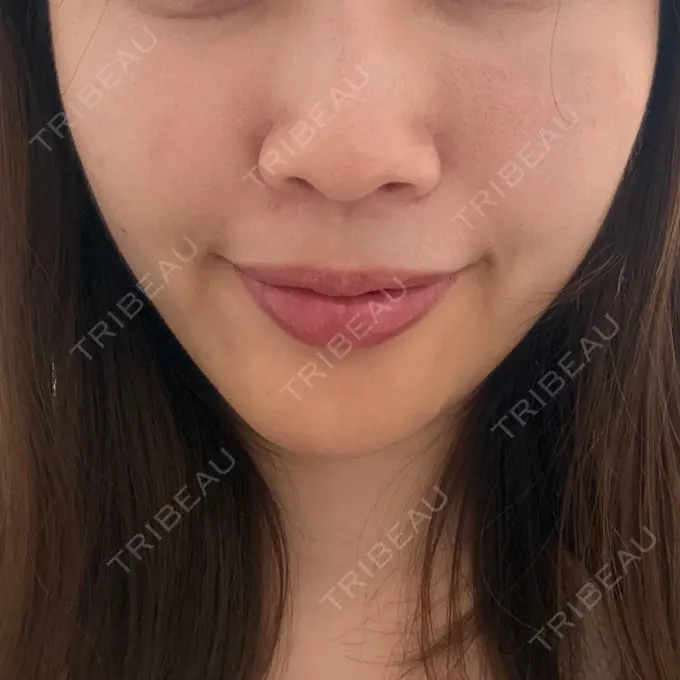 脂肪溶解注射（顔） 日比谷セントラルクリニック AFTER メイン用