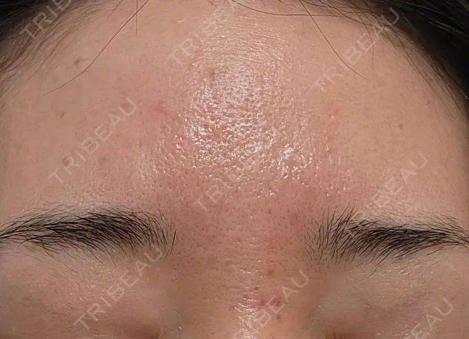 リジュラン 湘南美容クリニック Regno 銀座院 AFTER メイン用