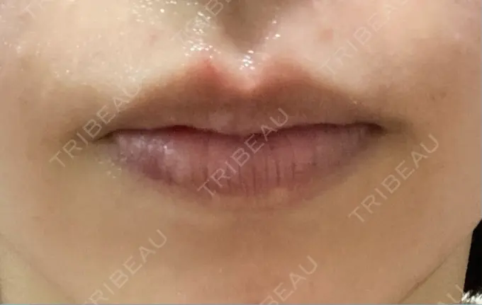 ヒアルロン酸注入（唇） HAAB×DREAM BEAUTY CLINIC 大阪梅田院 DAY 5 メイン用