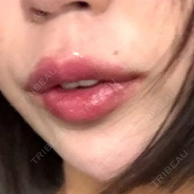ヒアルロン酸注入（唇） 目白ホワイトクリニック DAY 10 メイン用