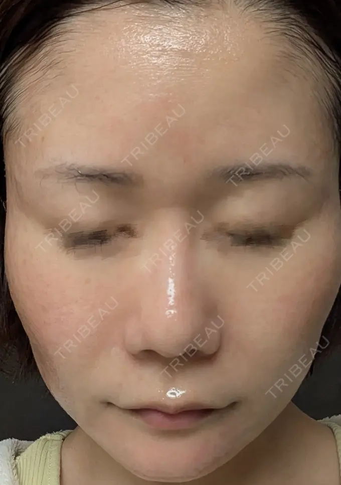 水光注射（ハリ・美肌） / ピーリング（ニキビ・毛穴） / ピーリング（ハリ・ツヤ） DAILY SKIN CLINIC 心斎橋院 AFTER メイン用